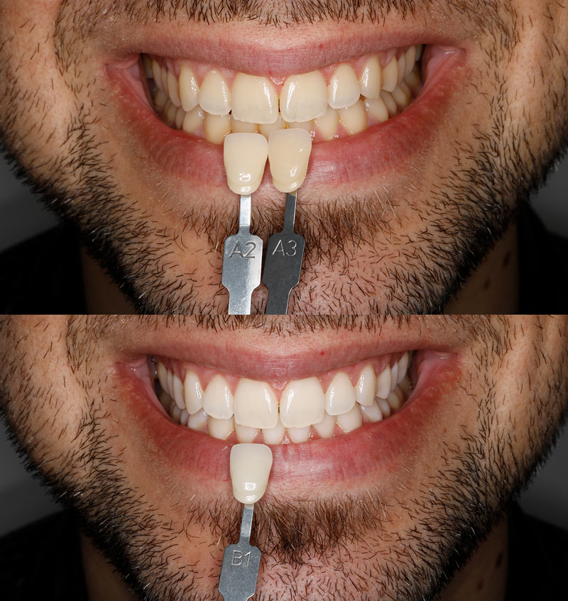 hacerte molestar America referir Blanqueamiento dental en Las Rozas (Madrid) | Clínica Dental Trei