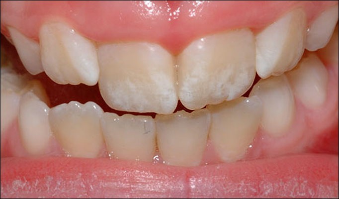fluorosis dental