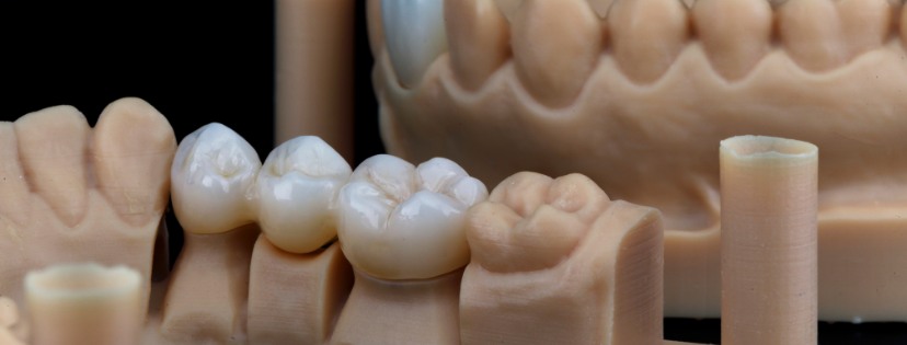 coronas-dentales